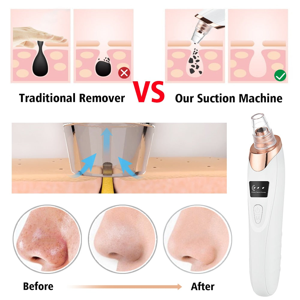 JUST IN!!! Blackhead Remover Vacuum